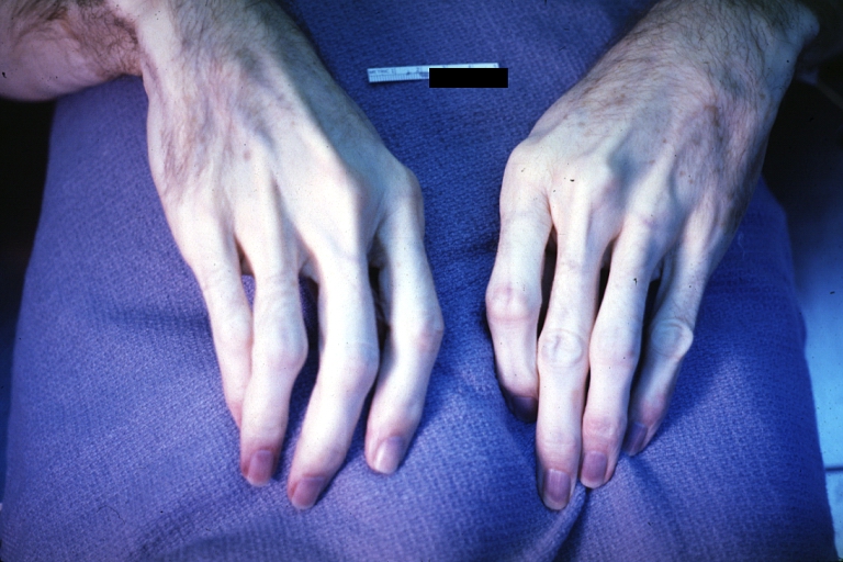 Hand: Acrocyanosis: Gross, an excellent example