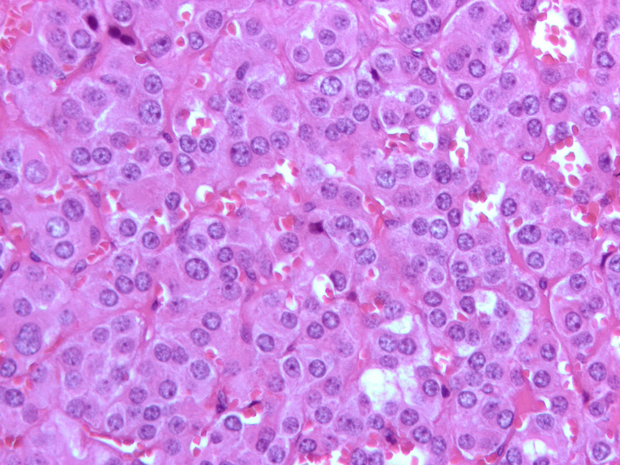Micrograph of a pheochromocytoma (at high magnification) showing the characteristic stippled (finely granular) chromatin. The chromatin pattern is sometimes referred to as "salt-and-pepper" chromatin