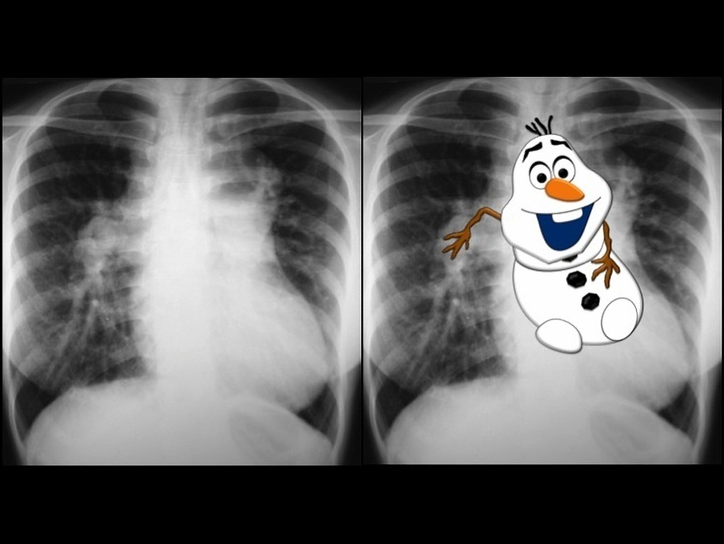 File:Total-anomalous-pulmonary-venous-return-4.jpg