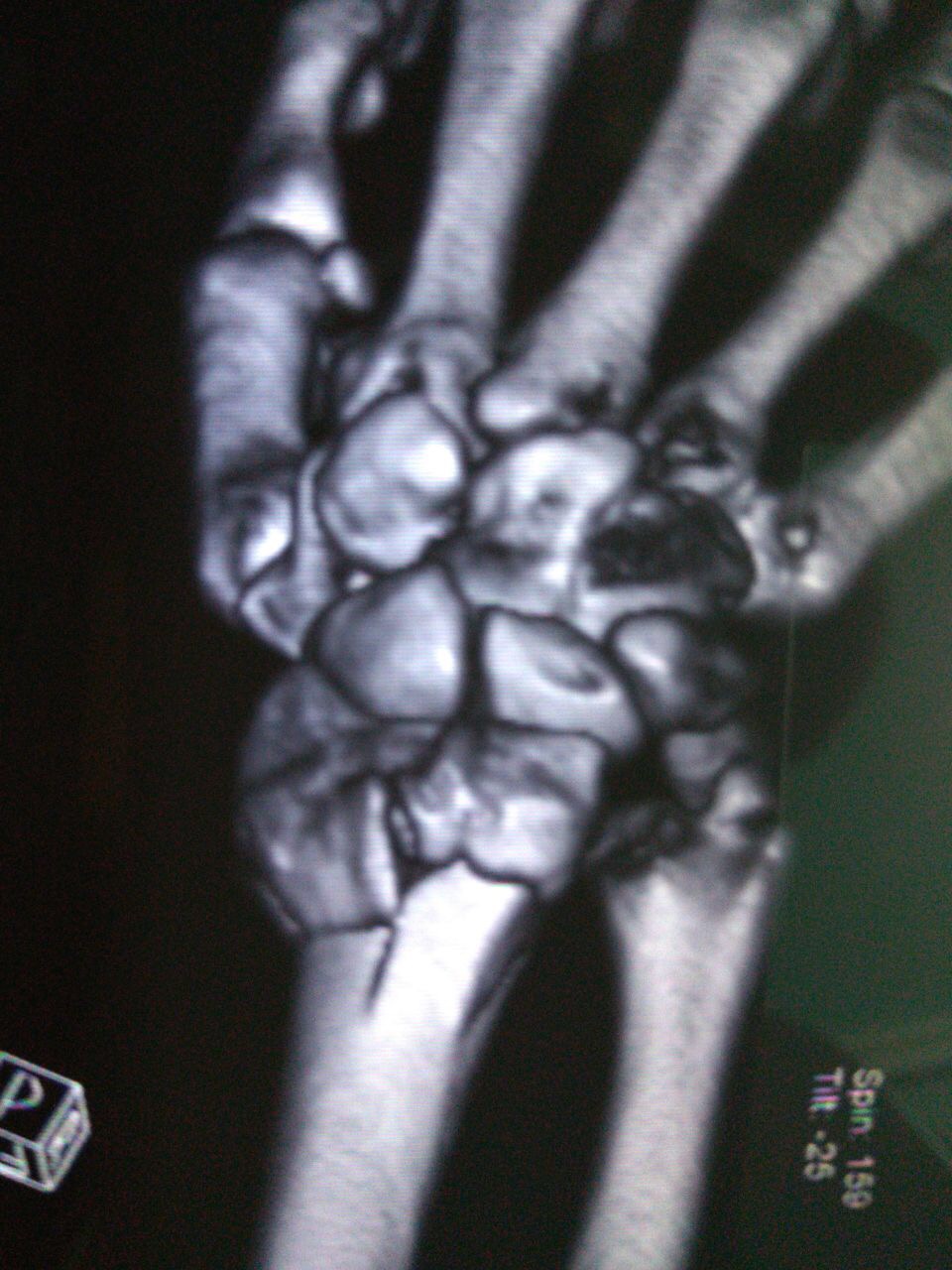 File:CT scan Wrist dorsal view.JPG