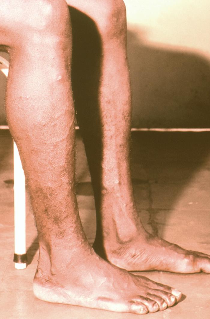 Right lateral surface of a patient’s right lower leg and foot with classic maculopapular rash of chickenpox. From Public Health Image Library (PHIL). [27]