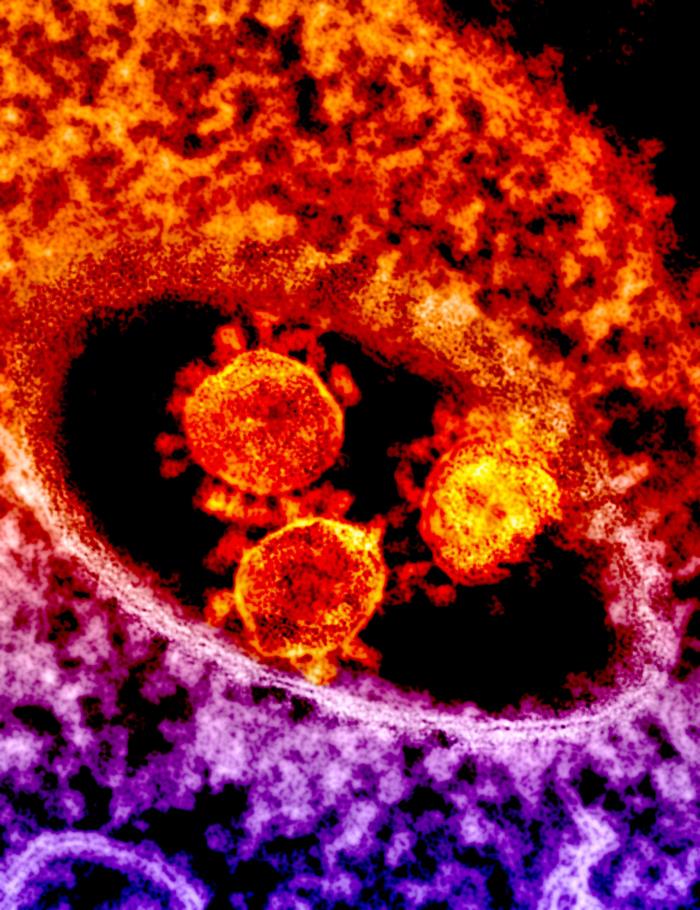 TEM reveals ultrastructural details exhibited by a number of red-colored, spherical-shaped Middle East Respiratory Syndrome Coronavirus (MERS-CoV) virions. From Public Health Image Library (PHIL). [1]