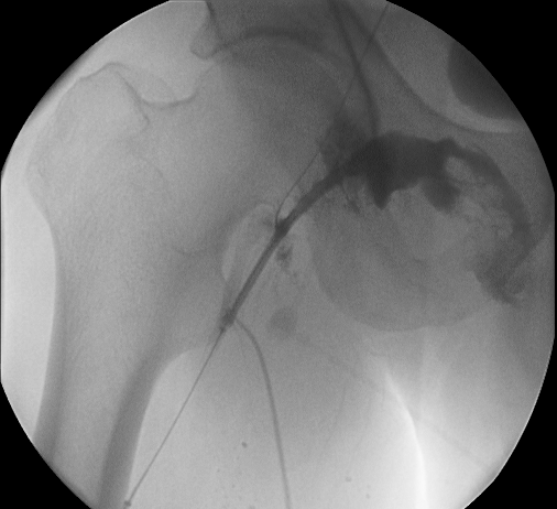 Complication during right femoral artery puncture. Image courtesy of C. Michael Gibson and copylefted.