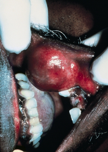 SALIVARY GLANDS: CANALICULAR ADENOMA. The upper lip is the site for over 70% of canalicular adenomas.