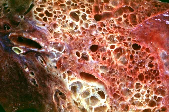 File:Scleroderma lung 3.jpg