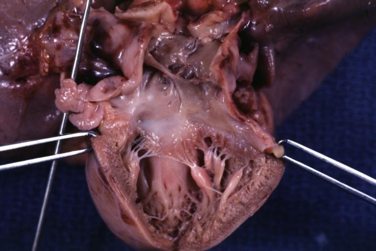 Cor Triatriatum: Gross fixed tissue opened left atrium mitral valve and left ventricle