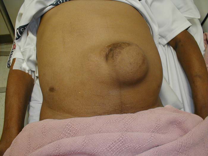 Umbilical Hernia: Protrusion of intra-abdominal contents through defect in posterior fascia.