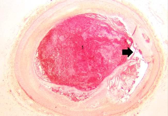 This is a low-power photomicrograph of thrombosed coronary artery. The thrombus (1) completely occludes the vessel. Note the layering of the thrombus. The fibrous cap is ruptured (arrow) and there is hemorrhage into the atherosclerotic plaque. Note the cholesterol crystals in the plaque.