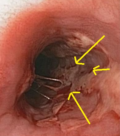 File:Herpes esophagitis - By Donald E. Mansell, MD - Own work, CC BY-SA 3.0, httpscommons.wikimedia.orgwindex.phpcurid=9666173 (22).jpg