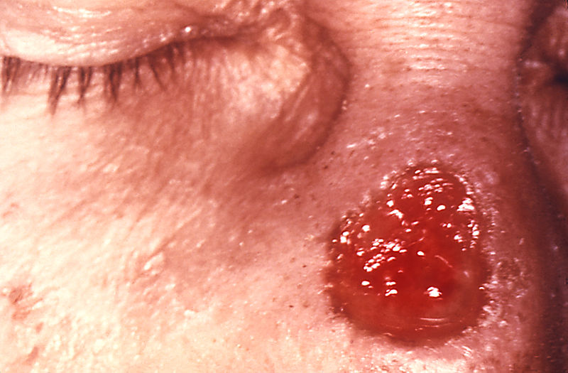 A gumma of nose due to a long standing tertiary syphilitic Treponema pallidum infection.