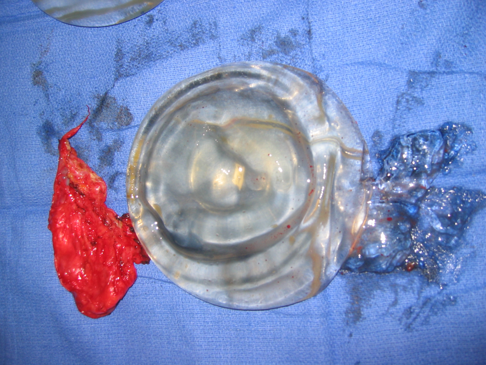 File:Ruptured implant.JPG