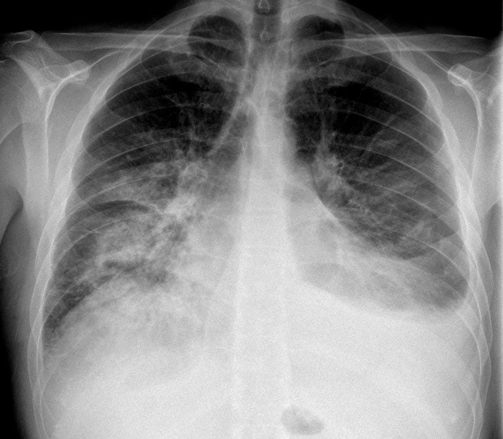 File:Unilateral-pulmoary-oedema-cardiogenic-1.jpg