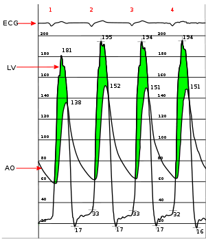 Aortic Stenosis Hemodynamic Pressure Tracing.