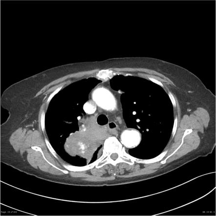File:Ct lung cancer.jpg