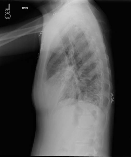 Chest x-ray: Disseminated Tuberculosis