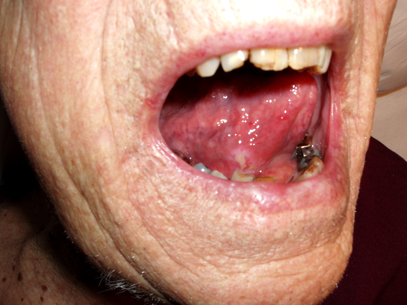 Squamous Cell Cancer, Base of Tongue: Note white area with swelling, right base of tongue.