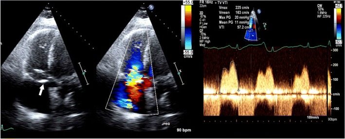File:Tricuspid stenosis in echocardiography.jpg