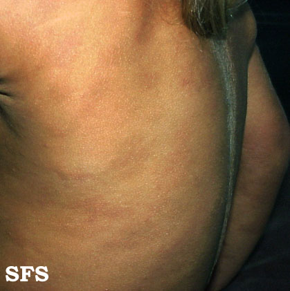 Urticaria pigmentosa. Adapted from Dermatology Atlas.[1]