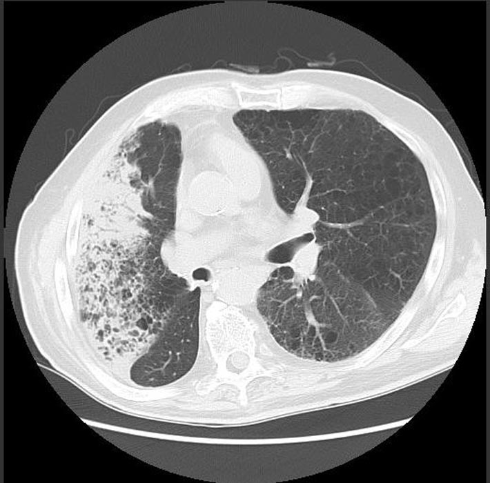 CT SCAN: Bronchoalveolar Carcinoma