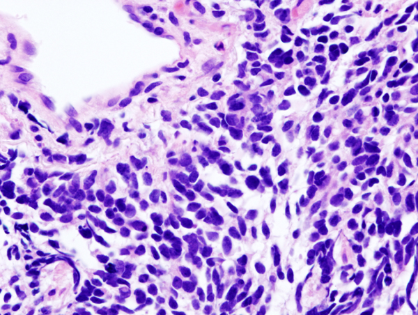 Histopathologic image of small cell carcinoma of the lung. CT-guided core needle biopsy. H & E stain.via Wikimedia Commons By No machine-readable author provided. KGH assumed (based on copyright claims). [GFDL (http://www.gnu.org/copyleft/fdl.html) or CC-BY-SA-3.0 (http://creativecommons.org/licenses/by-sa/3.0/)],