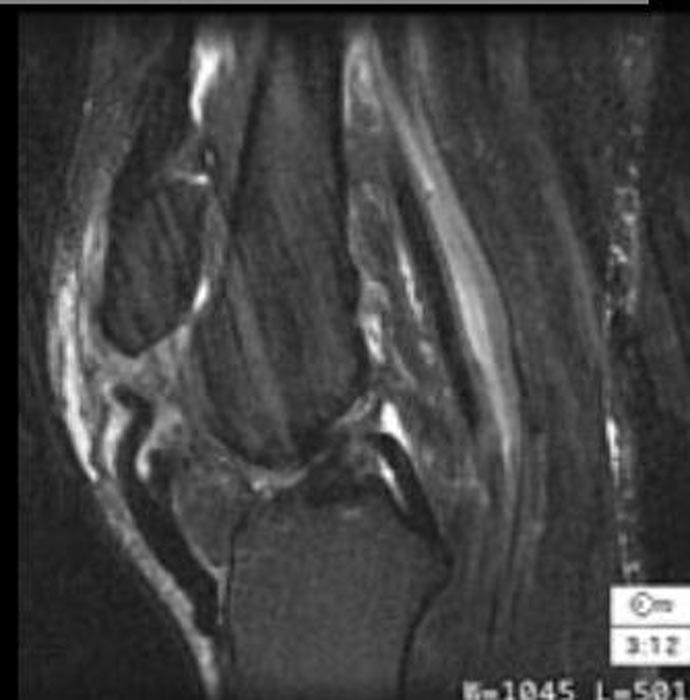 MRI: Patellar tendon rupture