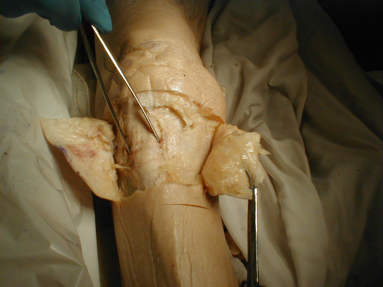 Patellar tendon: The tendon is grasped by forceps (gross dissection)