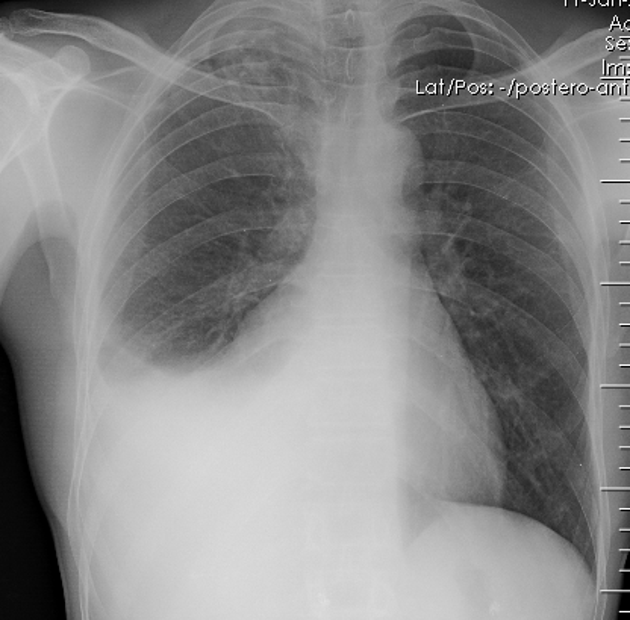 Right side pleural effusion. A homogenous opacification is noted in the right lower zone. The right costophrenic angle is obliterated with a meniscus noted.