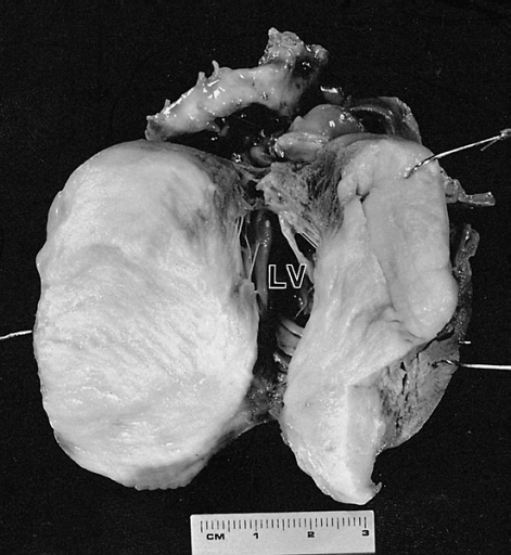 Cardiac Fibroma Cut surface of the tumor shown in figure 6-2. The left ventricular (LV) cavity is present behind the mass. The patient was a 4-month-old child who died suddenly without a previous medical history.