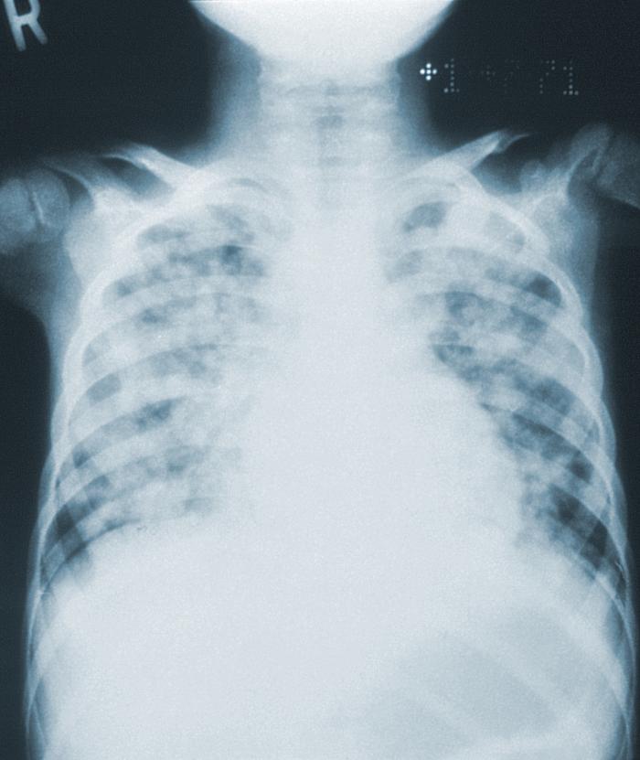 Bilateral pulmonary infiltrates throughout the entirety of each lung field in the case of a child with leukemia, as well as chickenpox pneumonia. From Public Health Image Library (PHIL). [1]