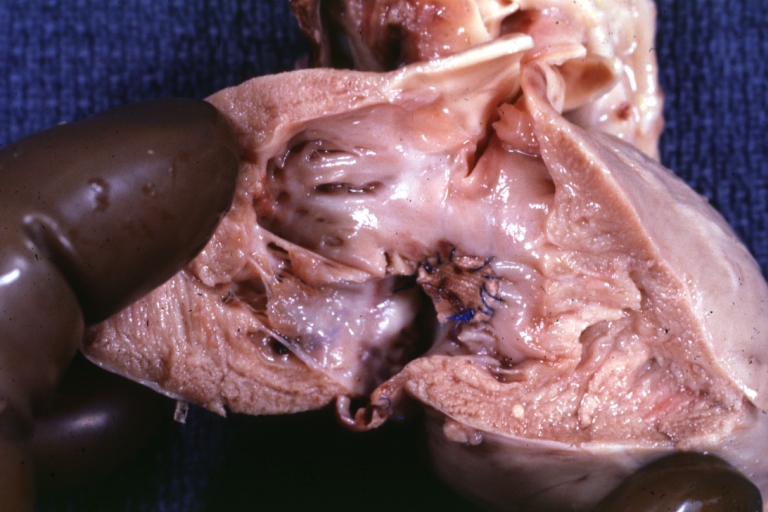 Perimembranous Ventricular Septal Defect: Gross, fixed tissue, lesion seen from right ventricle (with patch)