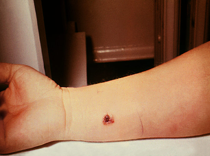 "Anthrax, skin of right forearm, 7th day.”Adapted from Public Health Image Library (PHIL), Centers for Disease Control and Prevention.[21]