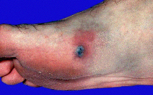 Skin lesion on foot in a patient with DGI