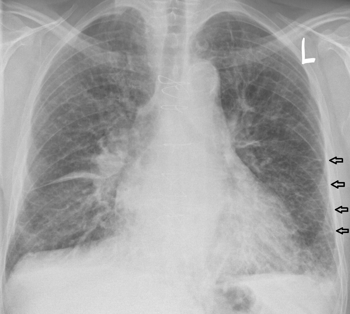 File:InkedChest radiograph of a lung with Kerley B lines - annotated LI.jpg
