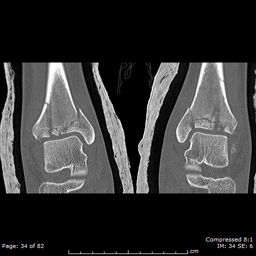 Severely comminuted tibial plafond fractures that extend into the metadiaphyseal regions which are bilateral and nearly symmetric. On the right, there is approximately 3mm of articular offest anteriorly, but otherwise the articular fragments are minimally displaced. There is 1mm medial offset of the medial malleolar fracture fragment on the left and 2mm on the right. There are several small sub-millimeter intraarticular fragments bilaterally.