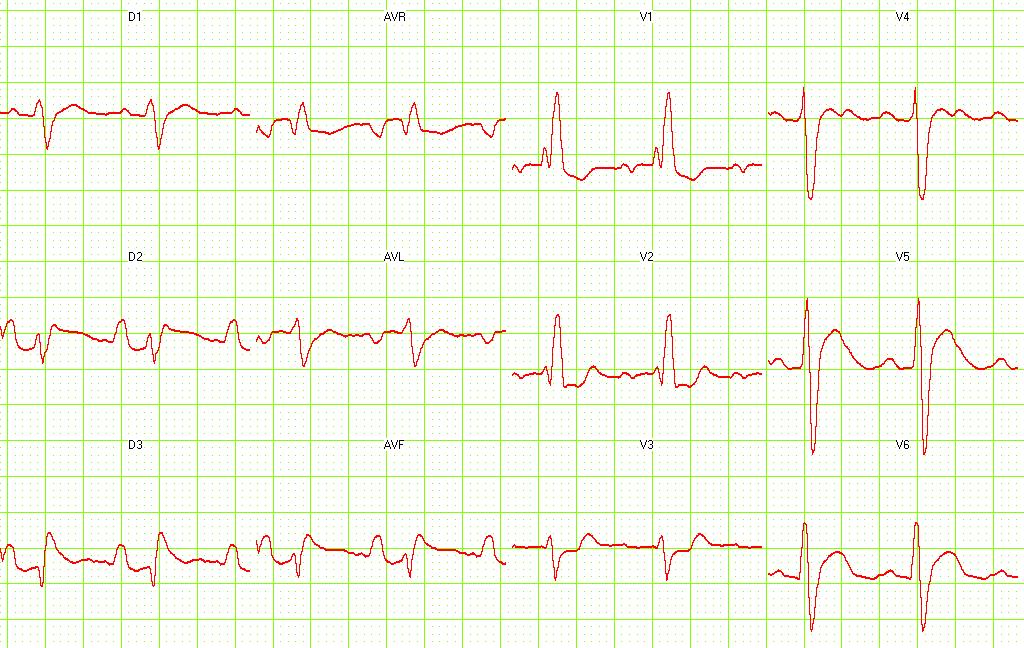 Right Bundle Branch Block with RA hypertrophy. Image courtesy of Dr Jose Ganseman