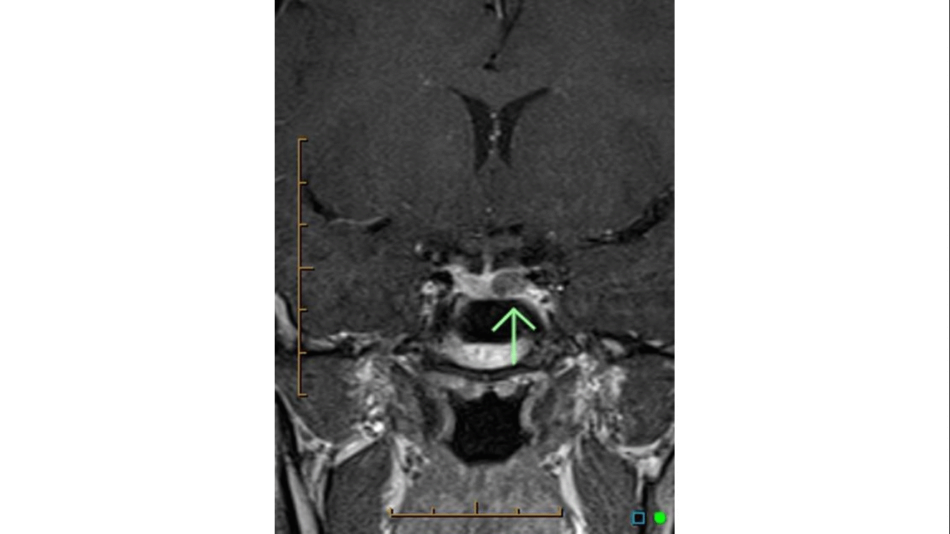 File:Coronal T1 contrast enhanced mri image showing microadenoma.gif