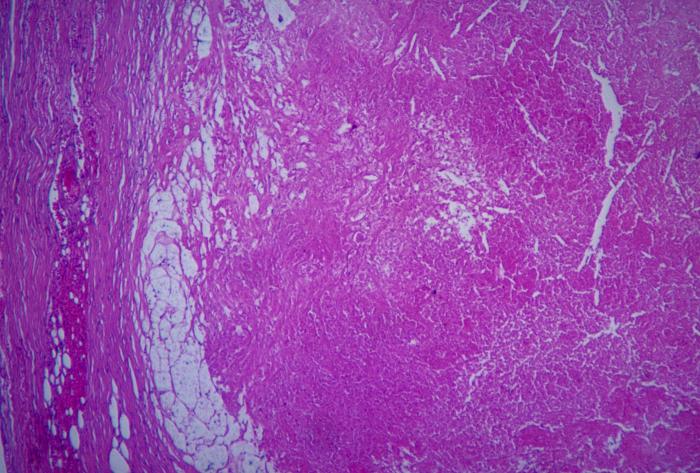 Micrograph depicts the histopathologic changes associated with cryptococcosis of an adrenal gland. From Public Health Image Library (PHIL). [10]