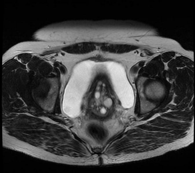 File:Large nabothian cysts MRI 003.jpg