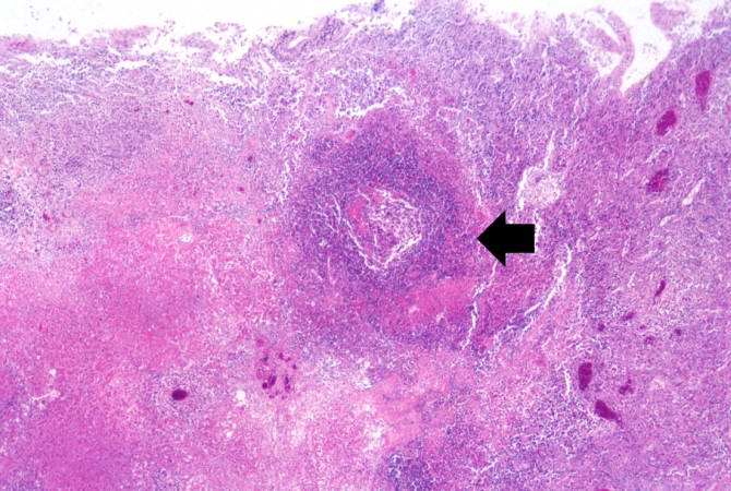 This high-power photomicrograph demonstrates a small abscess (arrow) with a necrotic center.