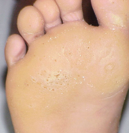 Pitted keratolysis. With permission from Dermatology Atlas.[2]