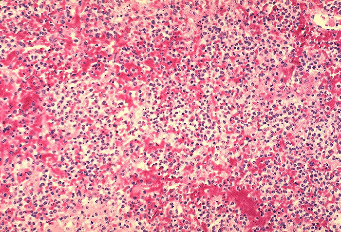 Histopathology of lung in fatal human plague. Area of marked fibrinopurulent pneumonia Adapted from Public Health Image Library (PHIL), Centers for Disease Control and Prevention.[19]
