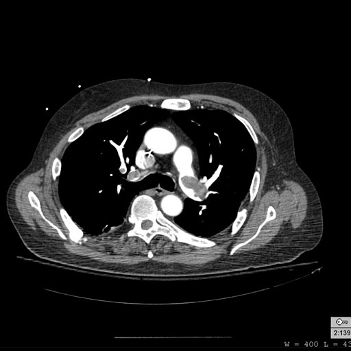 Pulmonary embolism: Patient presented with Shortness of breath