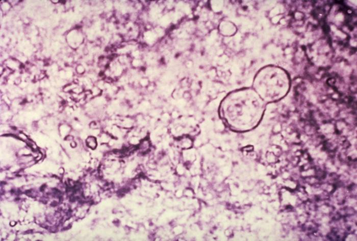 Smear from foot lesion of blastomycosis showing Blastomyces dermatitidis yeast cell undergoing broad-base budding. From Public Health Image Library (PHIL). [2]