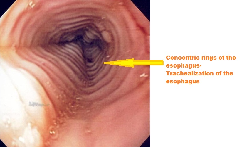 Endoscopy of the esophagus: Eosinophilic esophagitis Source: Wikimedia commons