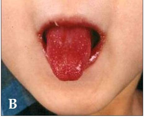 File:Kawasaki tongue.jpg