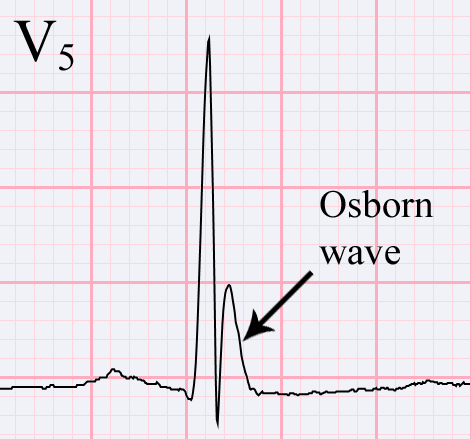 Osborn wave. 81-year-old black male with BP 80/62 and temperature 89.5 degrees F (31.94 C)