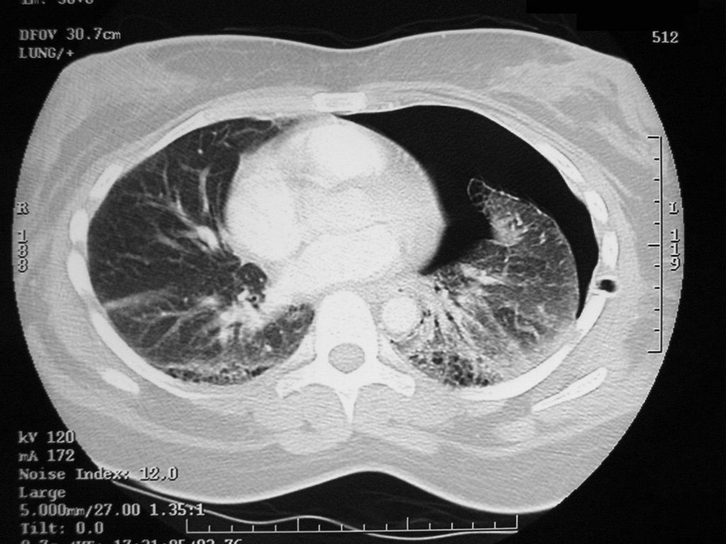 Left-sided pneumothorax (on the right side of the image) on CT scan of the chest. A chest tube is in place--side of chest, the lumen (black) can be seen adjacent to the pleural cavity (black) and ribs (white). The heart can be seen in the centre.