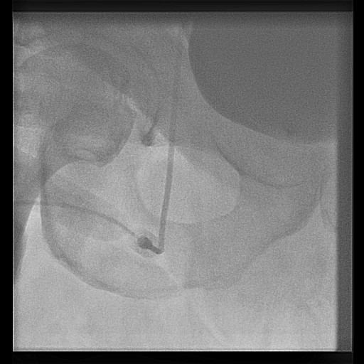 Higher Level Puncture of Femoral Artery and Cannula Kinking. Image courtesy of C. Michael Gibson and copylefted.