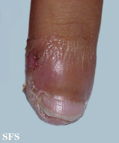 Acrodermatitis continua. [http://atlasdermatologico.com.br/disease.jsf?diseaseId=11