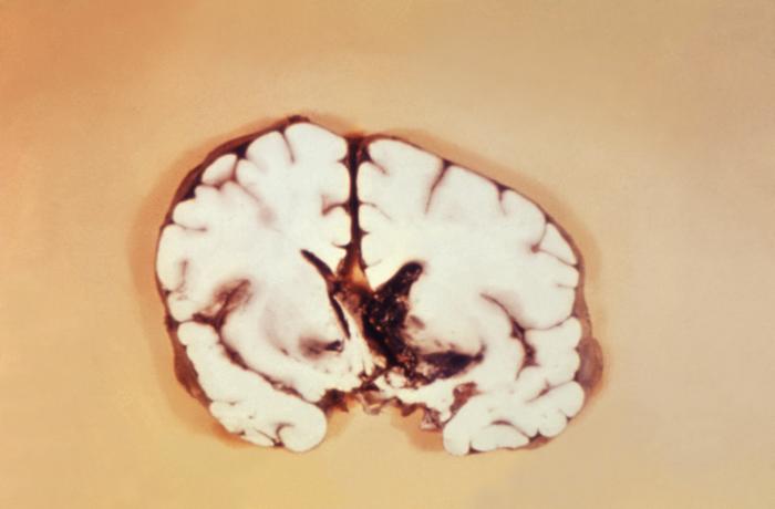 Brain section through the ventricles revealing an inter ventricular hemorrhage as consequence of virulence factors of Bacillus anthracis (edema toxin, lethal toxin, and antiphagocytic capsular antigen). The toxins are responsible for the primary clinical manifestations of hemorrhage, edema, and necrosis”Adapted from Public Health Image Library (PHIL), Centers for Disease Control and Prevention.[21]